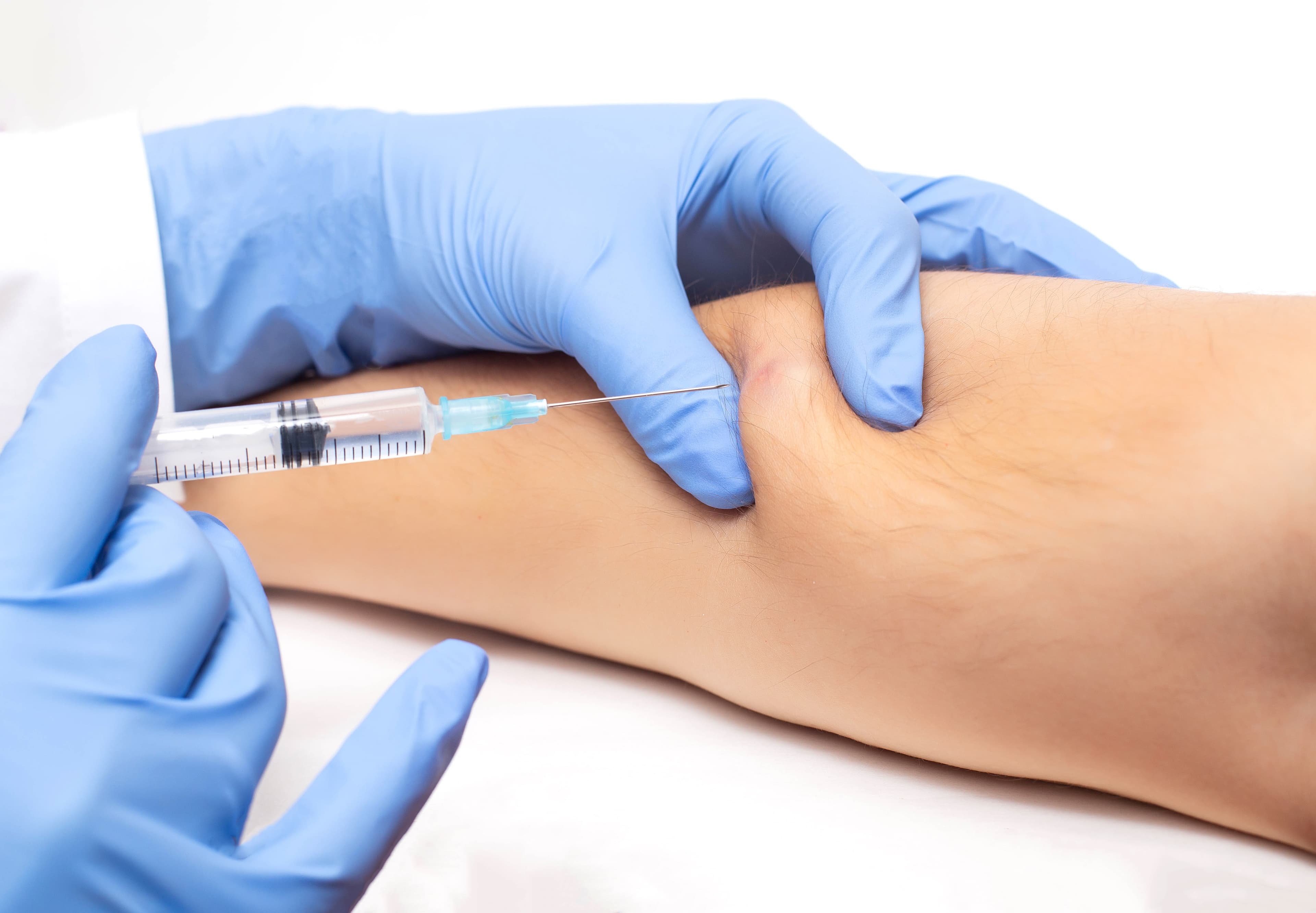 Formulação subcutânea de nivolumabe é aprovada pelo FDA para múltiplas indicações oncológicas