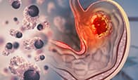 Pembrolizumabe recebe aprovação definitiva do FDA para câncer gástrico HER-2 positivo com expressão de PD-L1